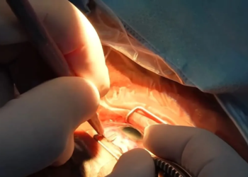 Cirugías de cataratas gratis en Q. Roo | Gobierno de Mara Lezama