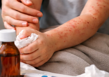 Casos de sarampión en 2026 ya superan todo 2025 y encienden alerta sanitaria en México 2 Casos de sarampión en 2026 ya superan todo 2025 y encienden alerta sanitaria en México